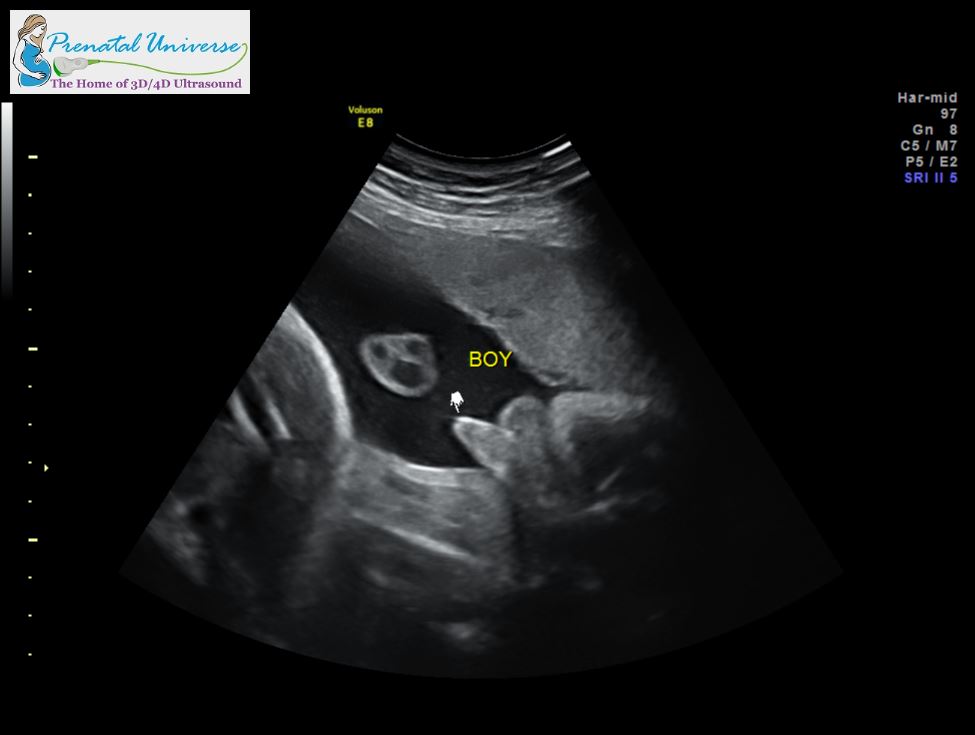 its a boy ultrasound